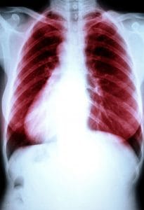 Image de Maladies Pulmonaires