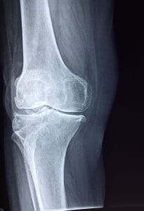 Image de Maladies Des Os