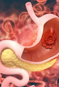 Image de Maladies Cancérigènes